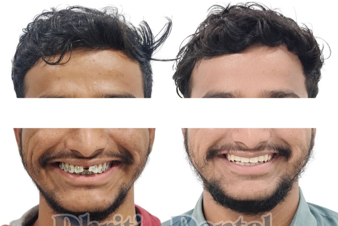 Braces Treatment at Dhriti Dental